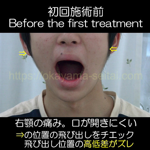 初回施術前の顎のズレ