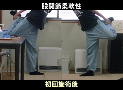 初回施術後：左股関節の可動制限が解け伸びてきた