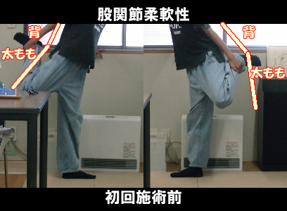 初回施術前：左股関節の可動制限の状態