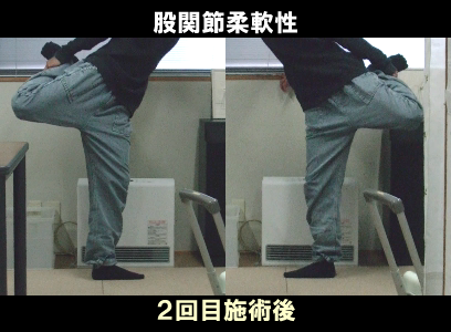 ２回目施術後：左股関節の可動制限の状態