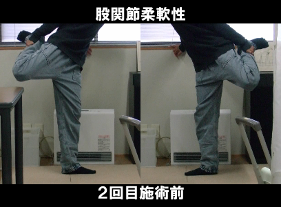 ２回目施術前：左股関節の可動制限の状態