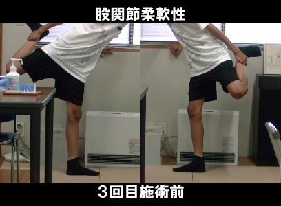 ３回目施術前：左股関節の可動制限の状態