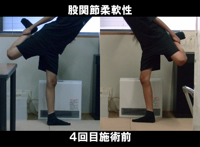 ４回目施術前：左股関節の可動制限の状態