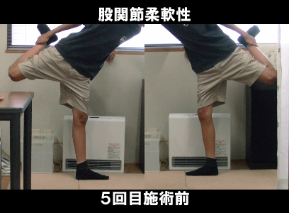 ５回目施術前：左股関節の可動制限の状態