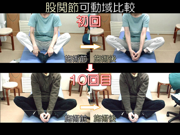 座って膝を広げる時の股関節可動域の変化の比較写真:初回-10回目