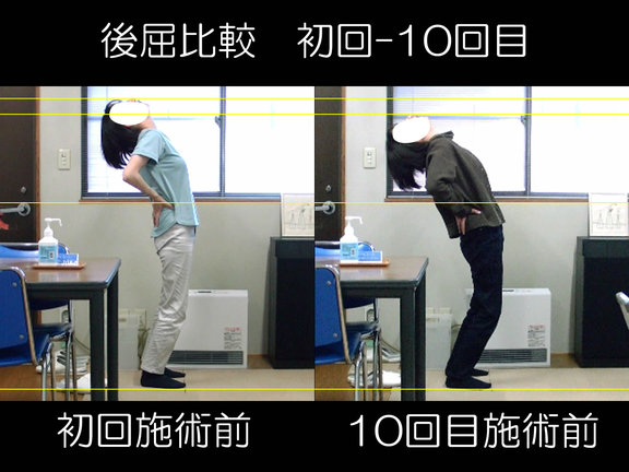 後屈可動域の変化の比較写真:初回-10回目