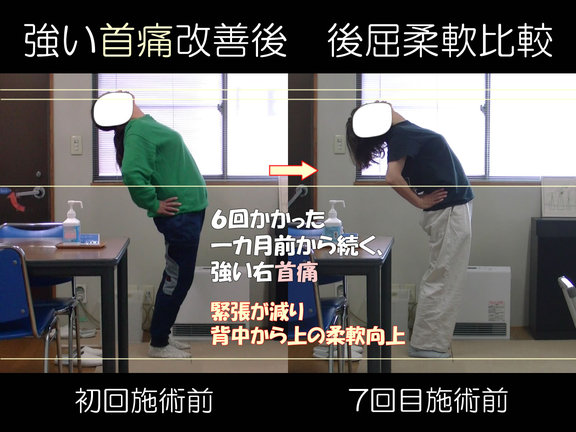 首痛改善後の後屈柔軟の変化:First-7th