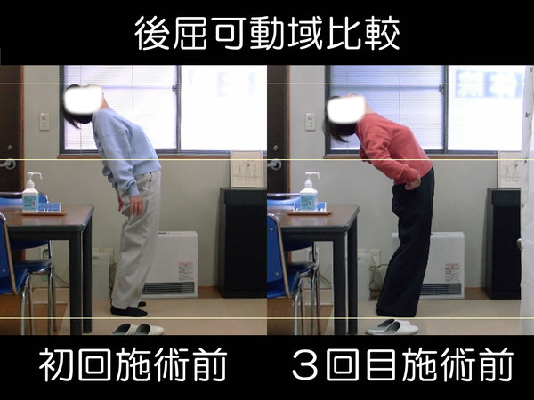 不眠・めまい・肩甲骨痛改善後の後屈柔軟の変化：First-7th