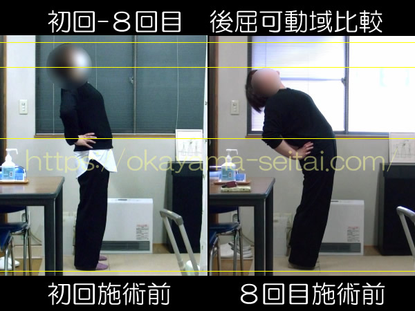 初回と8回目施術前の後屈可動域比較:可動域が本来の状態になった