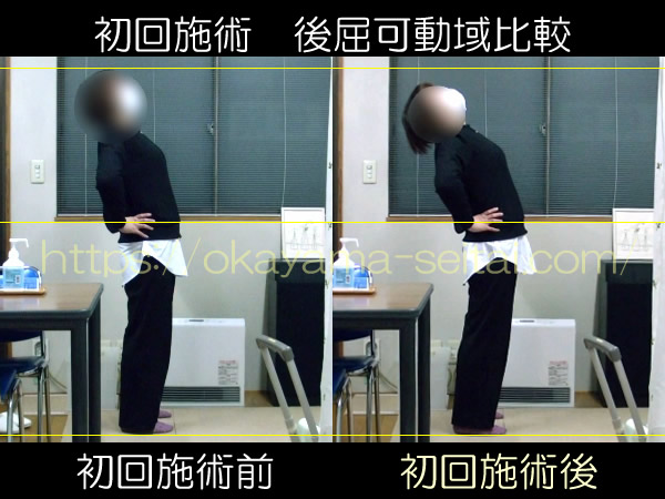 初回施術前後の後屈可動域比較:可動域がわずかに増してきた