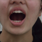 生理不順が改善した高校１年生（１年以上止まっていた生理が再開）